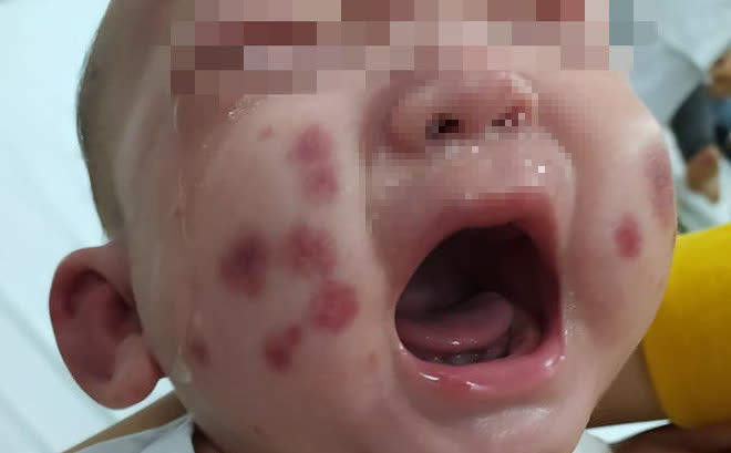 Bé trai đột nhiên xuất hiện mảng xuất huyết ở mặt, không ngờ là căn bệnh chưa từng ghi nhận ở Việt Nam - Ảnh 1.