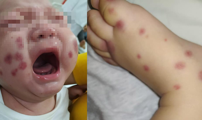 Bé trai đột nhiên xuất hiện mảng xuất huyết ở mặt, không ngờ là căn bệnh chưa từng ghi nhận ở Việt Nam - Ảnh 2.
