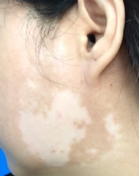 Mặt loang lổ sau khi b&ocirc;i kem trộn l&agrave;m đẹp - Ảnh 1.