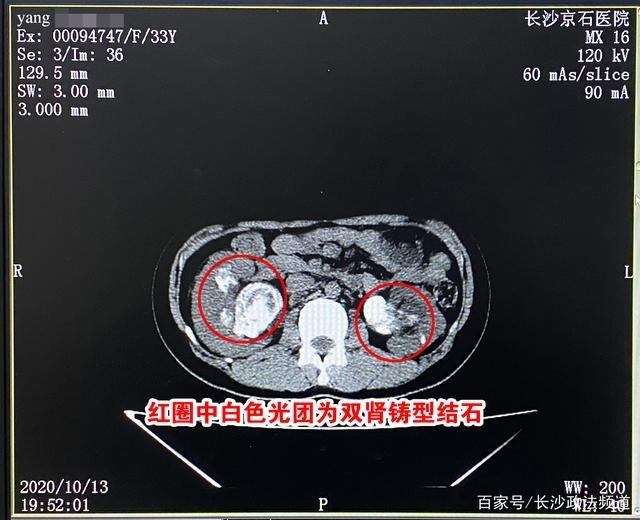 Người phụ nữ bị sốt liên tục suốt 8 năm, thận chảy mủ, nguyên nhân xuất phát từ thói quen mà nhiều người vẫn làm hàng ngày - Ảnh 2.