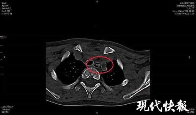 Đang ăn cơm, bé gái 3 tuổi bỗng nhiên ho dữ dội, mặt đỏ bừng, thứ gắp ra được từ thực quản của cô bé khiến các bố mẹ phải suy nghĩ lại về cách chăm con - Ảnh 3.