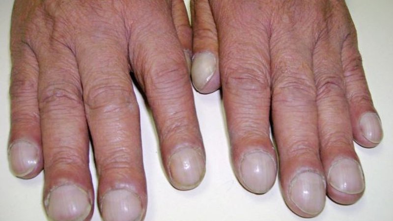Soi tay chân cũng có thể nhận biết được 5 biểu hiện cảnh báo bạn có nguy cơ mắc ung thư hay không - Ảnh 2.