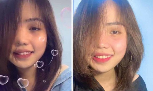 Cô gái bị chồng sắp cưới tạt axit hủy hoại nửa khuôn mặt và hành trình đau đớn để phục hồi nhan sắc ngoạn mục - Ảnh 2. Cô gái bị chồng sắp cưới tạt axit hủy hoại nửa khuôn mặt và hành trình đau đớn để phục hồi nhan sắc ngoạn mục - Ảnh 2.