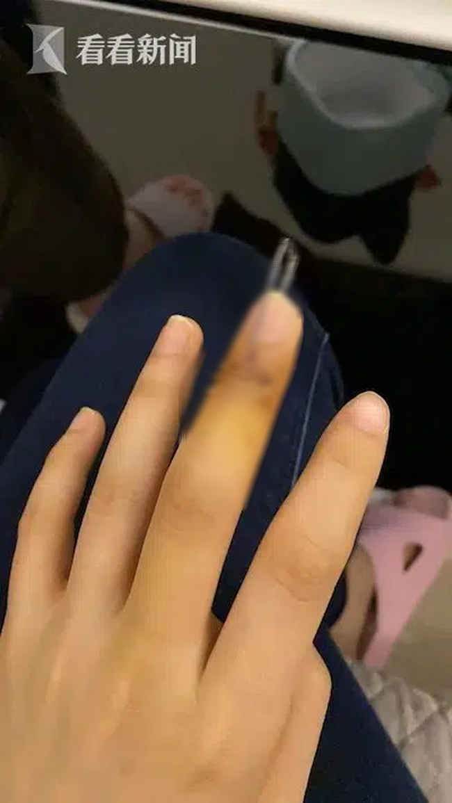 Người phụ nữ đột ngột đứt g&acirc;n ng&oacute;n tay khi đang đi vứt r&aacute;c, nguy&ecirc;n nh&acirc;n được tiết lộ khiến ai cũng phải tự ngẫm lại bản th&acirc;n m&igrave;nh - Ảnh 3.