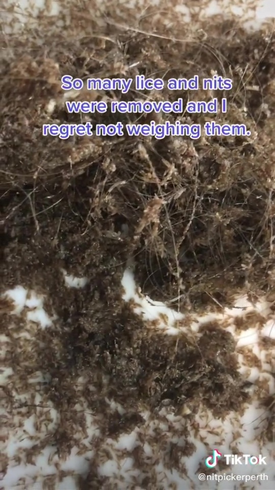 Mang quả đầu đỏ rát, lúc nhúc hàng ngàn con chấy đến salon, cô bé khiến chuyên gia khóc thét vì sốc và kết quả đáng kinh ngạc sau đó - Ảnh 4. Mang quả đầu đỏ rát, lúc nhúc hàng ngàn con chấy đến salon, cô bé khiến chuyên gia khóc thét vì sốc và kết quả đáng kinh ngạc sau đó - Ảnh 4.