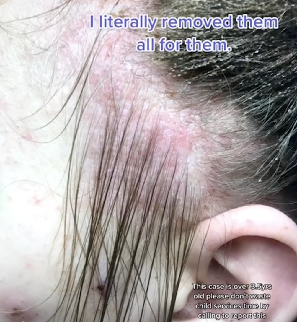 Mang quả đầu đỏ rát, lúc nhúc hàng ngàn con chấy đến salon, cô bé khiến chuyên gia khóc thét vì sốc và kết quả đáng kinh ngạc sau đó - Ảnh 2. Mang quả đầu đỏ rát, lúc nhúc hàng ngàn con chấy đến salon, cô bé khiến chuyên gia khóc thét vì sốc và kết quả đáng kinh ngạc sau đó - Ảnh 2.