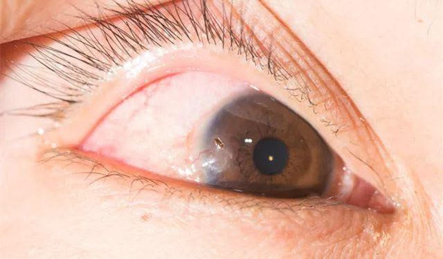 5 loại gỉ mắt bất thường đang cảnh báo bệnh tật nguy hiểm ở mắt nhưng thường bị bỏ qua - Ảnh 1.
