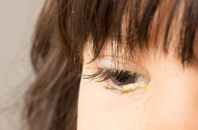 5 loại gỉ mắt bất thường đang cảnh báo bệnh tật nguy hiểm ở mắt nhưng thường bị bỏ qua - Ảnh 3.