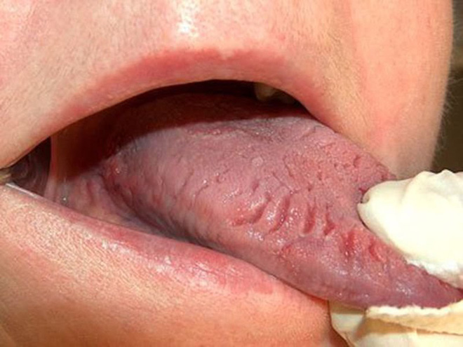 2 tổn thương trên lưỡi ngầm cảnh báo thực quản có vấn đề, đừng chủ quan bỏ qua - Ảnh 2.