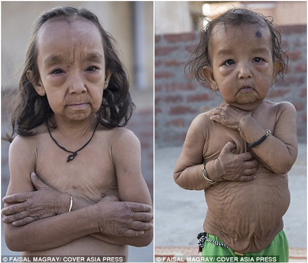 Two siblings have had the same super-aging disease since childhood, a tragic life that makes everyone sad - Photo 1.