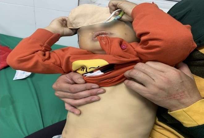 Chữa t&aacute;o b&oacute;n cho con bằng loại l&aacute; trồng ngo&agrave;i đường: Bố mẹ hối hận v&igrave; sai lầm chết người - Ảnh 3.