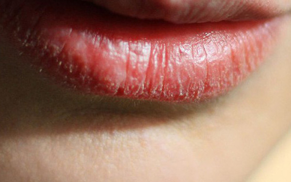Người có gan xấu thường có 4 biểu hiện trên đôi môi, mong rằng bạn không gặp điều nào - Ảnh 2.