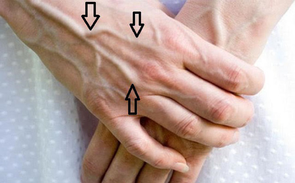 5 tín hiệu trên đôi bàn tay ngầm cảnh báo tế bào ung thư gan đã gõ cửa, cần chủ động kiểm tra ngay - Ảnh 1.