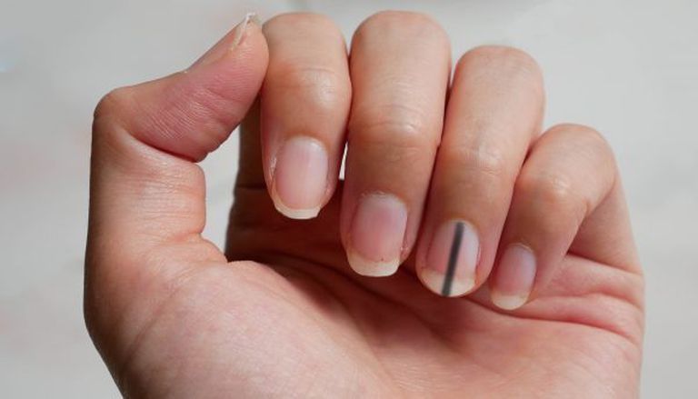 5 tín hiệu trên đôi bàn tay ngầm cảnh báo tế bào ung thư gan đã gõ cửa, cần chủ động kiểm tra ngay - Ảnh 2.