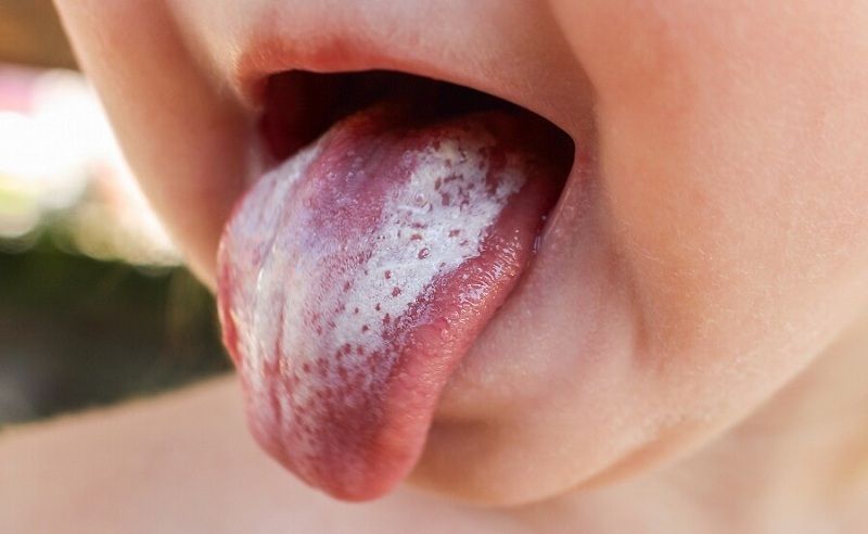 3 dấu hiệu bất thường trong khoang miệng ngầm cảnh báo nguy cơ mắc bệnh về gan cao - Ảnh 3.