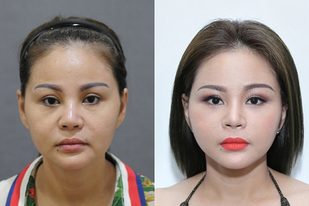 Nữ hoàng dao kéo&quot; Lê Giang kể về kỉ lục phẫu thuật thẩm mỹ: &quot;Tôi sửa mũi 10 lần, mắt 1 lần, cằm 2 lần, lấy cả sụn tai đắp vào mũi&quot;