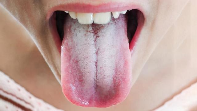 3 biểu hiện bất thường trên miệng ngầm cảnh báo dạ dày đang tồn tại vi khuẩn HP - Ảnh 1.