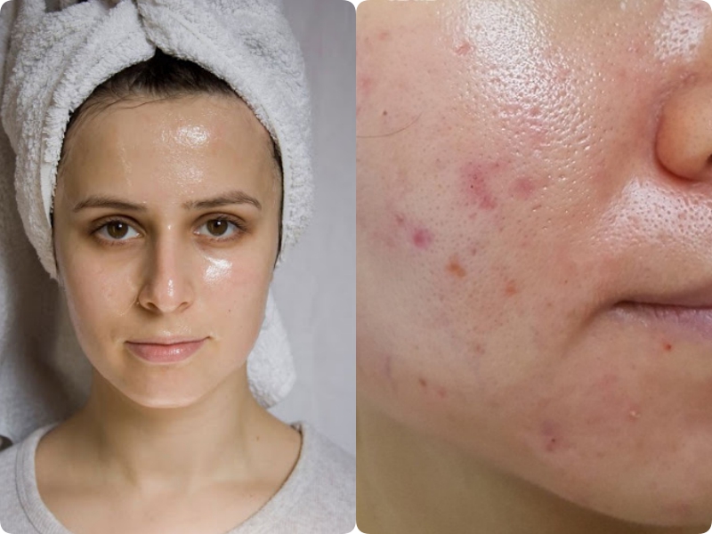 Da dầu thiếu ẩm, lỗ chân lông to ngoác và mụn hoành hành: Muốn khắc phục cần làm đúng 3 bước này - Ảnh 1. Da dầu thiếu ẩm, lỗ chân lông to ngoác và mụn hoành hành: Muốn khắc phục cần làm đúng 3 bước này - Ảnh 1.