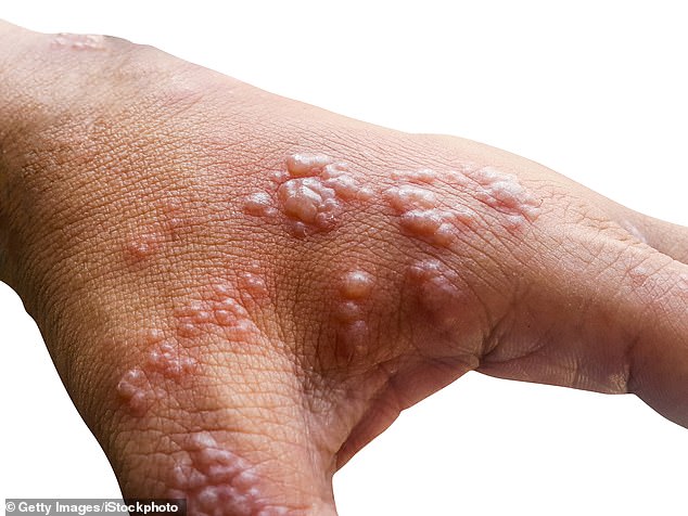 Xuất hiện thêm tác dụng phụ nghi do tiêm vaccine COVID-19 của Pfizer  - Ảnh 1.