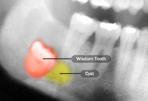 Răng khôn là gì mà khiến Phí Phương Anh ví như mối tình đầu làm mình đau? - Ảnh 3.