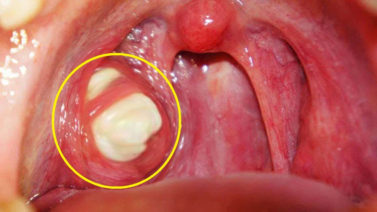 Tưởng bị cảm lạnh thông thường, ai ngờ amidan của người đàn ông 30 tuổi phình to, chảy mủ ròng ròng - Ảnh 2.