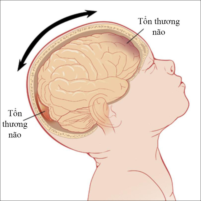 Bé gái 8 tháng tuổi bị bại não vì ông bà nội bế trên tay rung lắc cho cháu ngủ trong một thời gian dài - Ảnh 2.