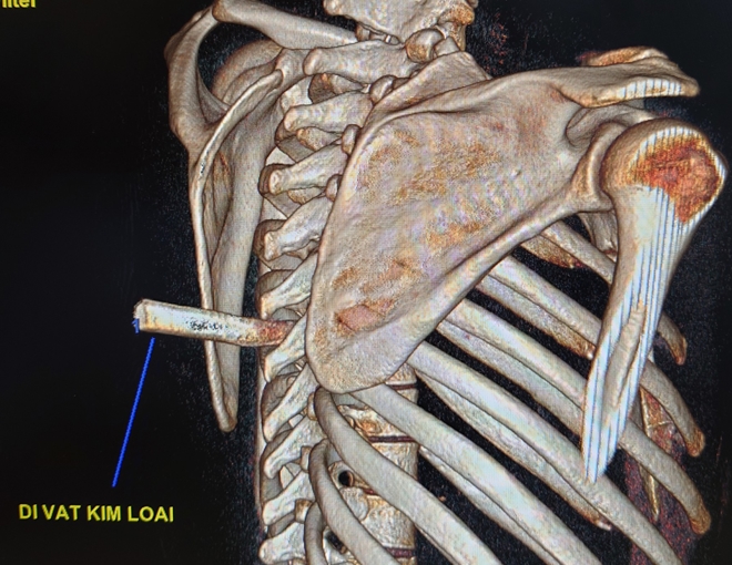 Mang cả mũi dao đâm vào cột sống đến bệnh viện - Ảnh 3.