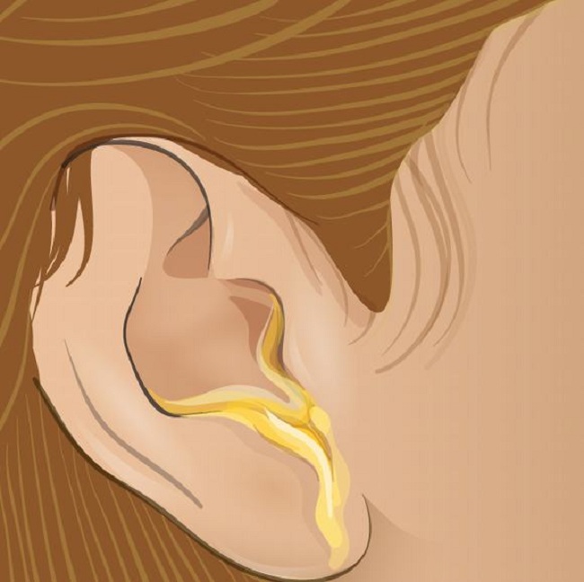 Nhìn vào ráy tai để nhận biết tình trạng sức khỏe, ráy tai bình thường trông như thế nào? - Ảnh 2.