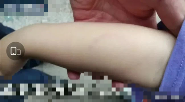 Con trai bị cắn bầm tay v&igrave; c&aacute;ch dạy lạ đời của gi&aacute;o vi&ecirc;n, mẹ hổ đến trường đ&ograve;i c&ocirc;ng bằng kh&ocirc;ng ngờ đấm g&atilde;y xương sườn c&ocirc; gi&aacute;o - Ảnh 1.