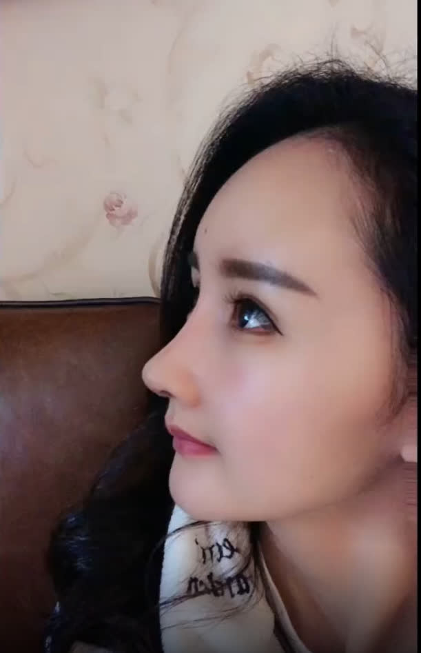 Nở rộ trào lưu phẫu thuật thẩm mỹ mũi và mép tóc giống Dương Mịch, dàn hotgirl xứ Trung giờ ai cũng như ai - Ảnh 14. Nở rộ trào lưu phẫu thuật thẩm mỹ mũi và mép tóc giống Dương Mịch, dàn hotgirl xứ Trung giờ ai cũng như ai - Ảnh 14.