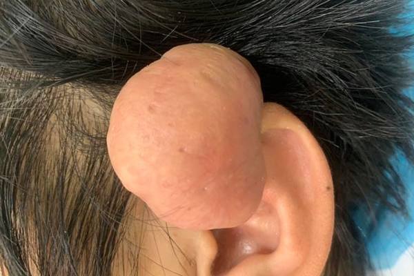Quảng Nam: Phẫu thuật thành công khối u sụn vành tai lớn hiếm gặp cho bệnh nhân - Ảnh 1.