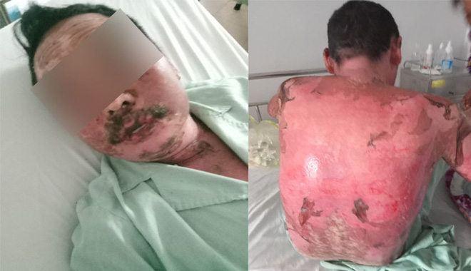 Dị ứng thuốc trị gout, người đ&agrave;n &ocirc;ng bong tr&oacute;c da to&agrave;n th&acirc;n - Ảnh 1.
