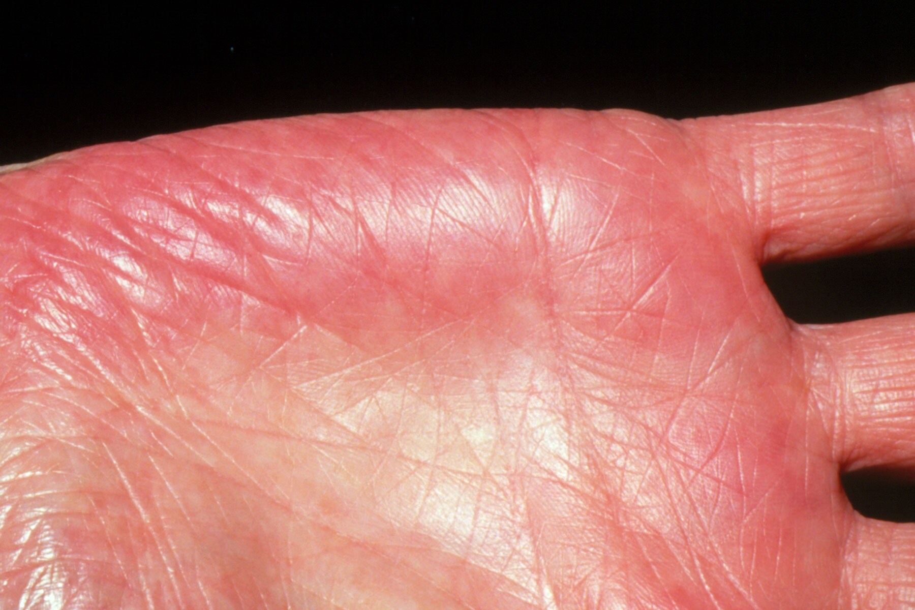 Người gan kém thường có 3 thay đổi bất thường ở bàn tay, đi khám ngay vì rất dễ là dấu hiệu của ung thư gan - Ảnh 2.