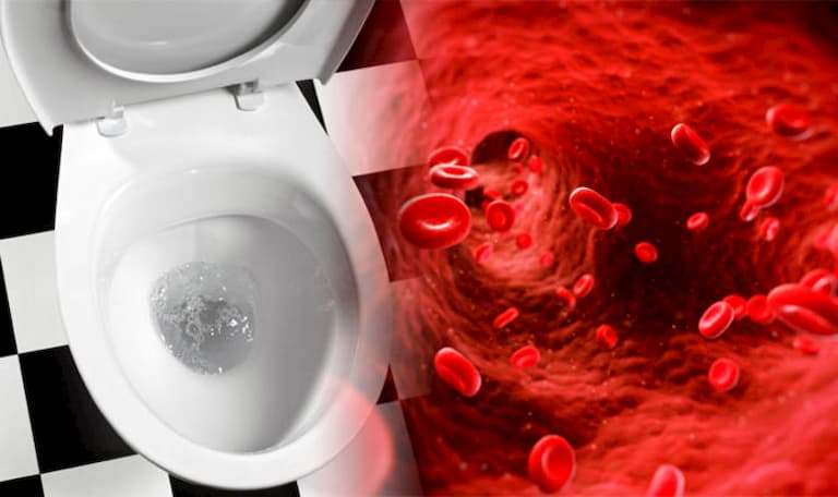 3 hiện tượng lạ khi đi vệ sinh là dấu hiệu tế bào ung thư đang nhen nhóm, đừng chủ quan bỏ qua - Ảnh 3.