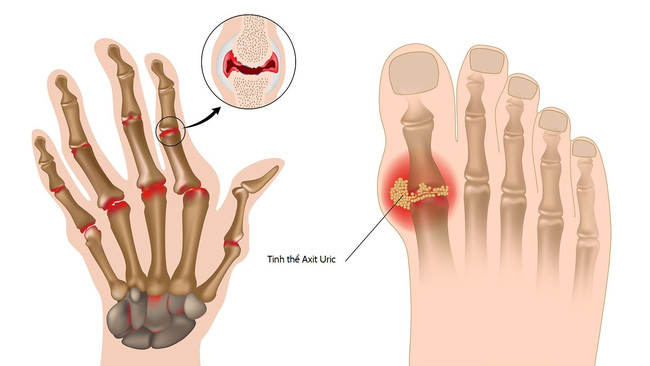 Hợp chất MOMILACTONE A & B là gì mà lại có khả năng ức chế, chống bệnh tiểu đường, ung thư, gout? - Ảnh 7.