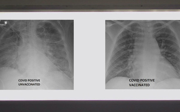 So sánh ảnh chụp phổi của bệnh nhân COVID-19 đã tiêm và chưa tiêm vaccine, phát hiện điều kinh ngạc - Ảnh 1.