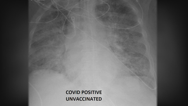 So sánh ảnh chụp phổi của bệnh nhân COVID-19 đã tiêm và chưa tiêm vaccine, phát hiện điều kinh ngạc - Ảnh 2.