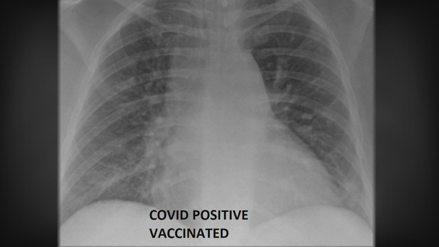 So sánh ảnh chụp phổi của bệnh nhân COVID-19 đã tiêm và chưa tiêm vaccine, phát hiện điều kinh ngạc - Ảnh 3.