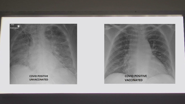 So sánh ảnh chụp phổi của bệnh nhân COVID-19 đã tiêm và chưa tiêm vaccine, phát hiện điều kinh ngạc - Ảnh 4.
