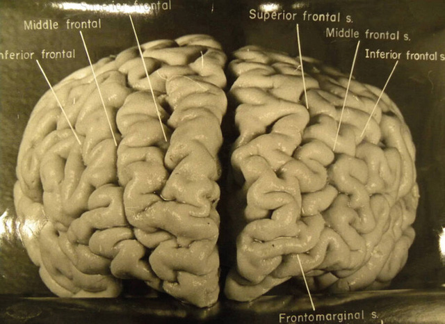 Chuyến Phiêu Lưu Của Bộ Não Albert Einstein, Người Có Iq Cao Nhất Thế Giới  Sau Khi Nó Bị Đánh Cắp Khỏi Cơ Thể