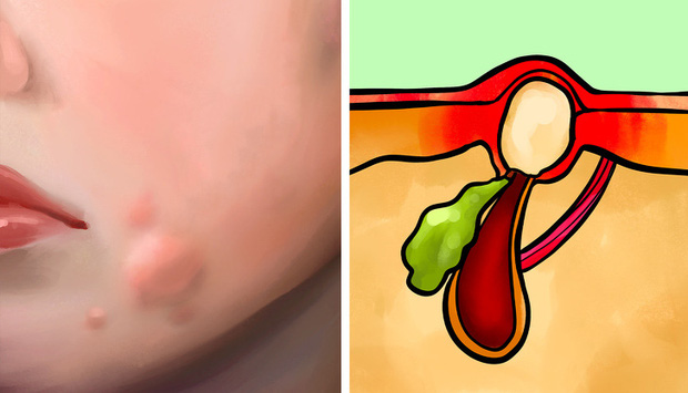 Nguyên nhân gây ra 6 loại mụn trứng cá phổ biến mà ít nhất ai cũng từng gặp phải một lần trong đời - Ảnh 6.