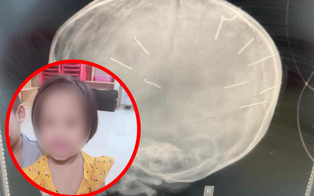 Kinh hoàng lời khai ban đầu của Nguyễn Trung Huyên: Đóng đinh vào đầu, đánh đập, hành hạ khiến bé gái 3 tuổi phải 4 lần nhập viện Kinh hoàng lời khai ban đầu của Nguyễn Trung Huyên: Đóng đinh vào đầu, đánh đập, hành hạ khiến bé gái 3 tuổi phải 4 lần nhập viện