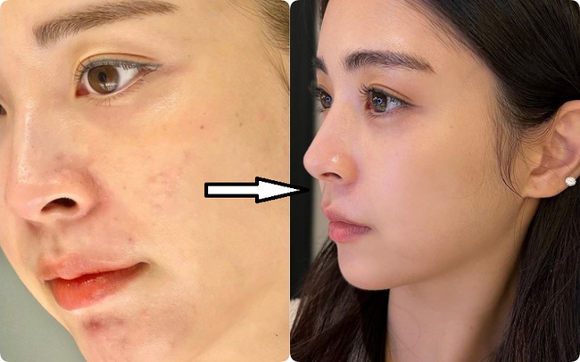 Thành phần sinh đôi với Retinol: Tăng sản xuất collagen trong da, khả năng trẻ hóa mạnh gấp mấy lần - Ảnh 2.