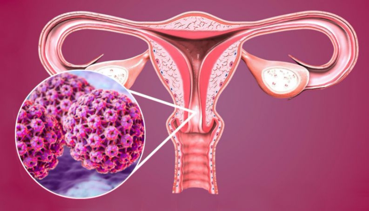 Người phụ nữ mắc ung thư cổ tử cung chỉ vì 3 thói quen xấu khi ăn uống, bạn cũng rất dễ mắc phải ngay từ điều đầu tiên - Ảnh 2.