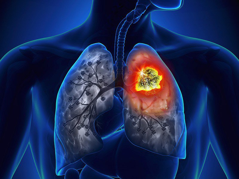 Tế bào ung thư phổi rất thích những người có 5 đặc điểm này, nếu có dù chỉ 1 cũng nên đi khám ngay - Ảnh 4.