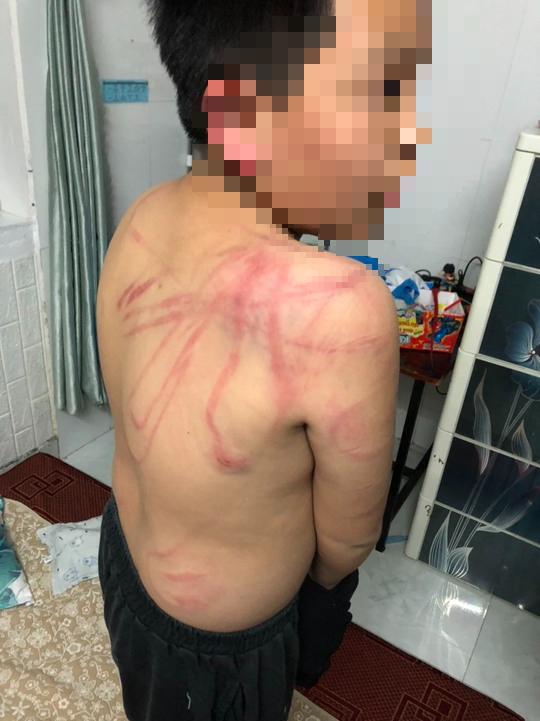 Lãnh đạo TP Đà Lạt thăm hỏi cháu trai 10 tuổi bị cha bạo hành dã man - Ảnh 1.