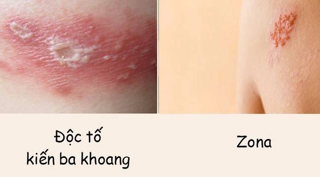 Nhiều người bị viêm da do tiếp xúc với kiến ba khoang: Phân biệt kiến ba khoang đốt và bệnh zona - Ảnh 1.