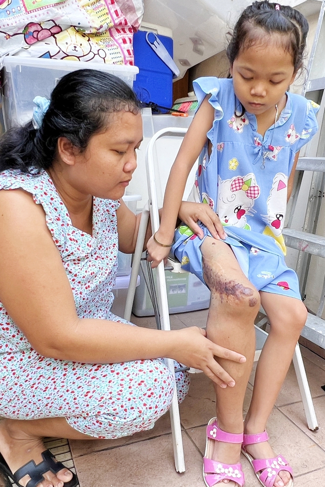 Hy vọng mong manh của bé gái 9 tuổi có thể mất đôi chân nếu không được chữa trị - Ảnh 3.