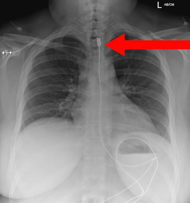 Cô gái nhập viện vì khó thở, bác sĩ bàng hoàng khi lấy ra dây sạc điện thoại dài 1 mét trong thực quản - Ảnh 2.