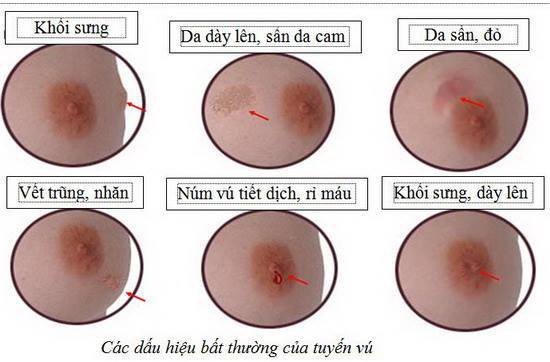 Bác sĩ cảnh báo về những điểm mù trong kiểm tra ung thư vú tại nhà thường bị bỏ qua - Ảnh 3.